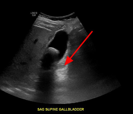 Posterior acoustic enhancement